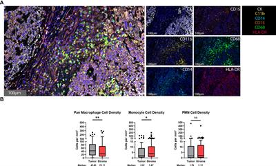 Multi-spectral immunofluorescence evaluation of the myeloid, T cell, and natural killer cell tumor immune microenvironment in chordoma may guide immunotherapeutic strategies